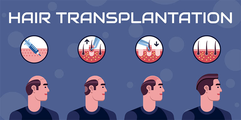 Hair-Transplantation